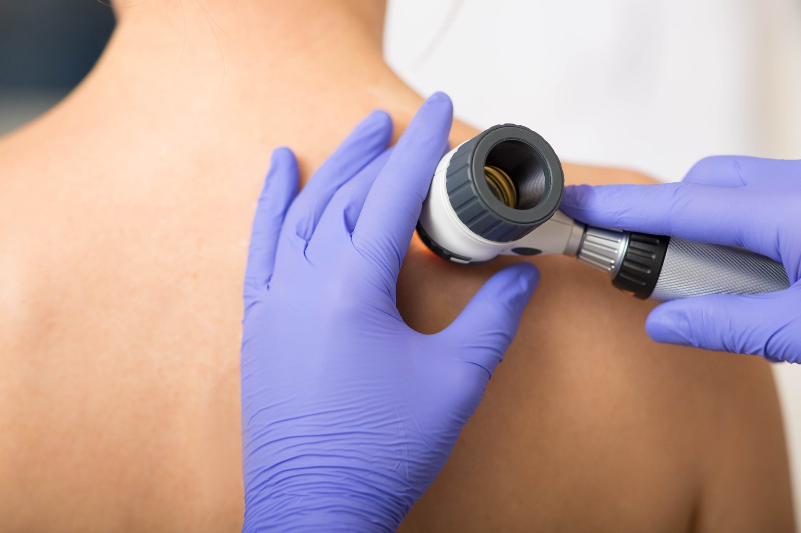 Dermatological skin examination with a dermatoscope at Ärztehaus Cumberland