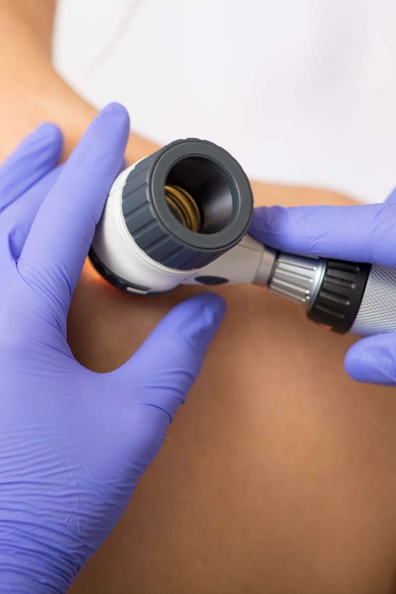 Dermatologische Untersuchung der Haut mit dem Dermatoskop im Ärztehaus Cumberland